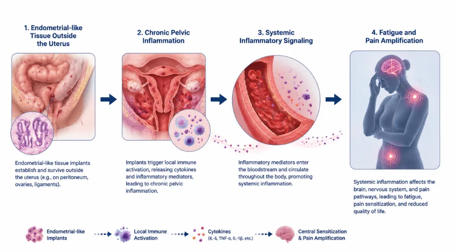 Simple diagram showing endometrial-like tissue outside the uterus, chronic pelvic inflammation, systemic inflammatory signaling, fatigue and pain amplification